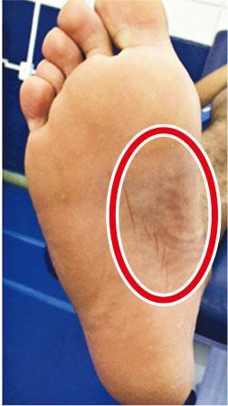 腳底瘀腫——足底筋膜撕裂會有瘀腫（見紅圈）在足底，患者在受傷後一般都難以走動。（作者提供）