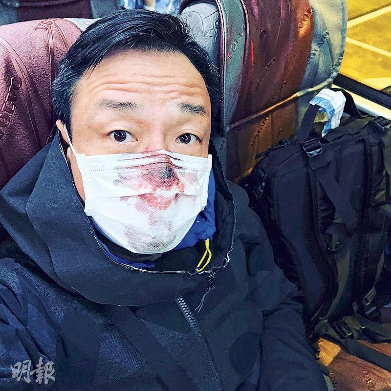 王喜前晚上載染血口罩照片，說入境台灣做PCR檢測被捅傷，「兇手」已逃離現場。（網上圖片）