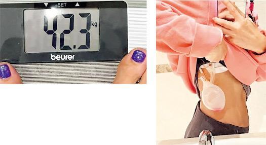 李玟日前在社交網貼出身上掛有醫療引流袋（右圖）和體重得42.3公斤（左圖）照片，健康狀况令人擔心。