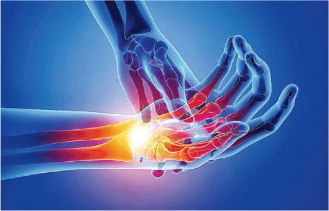 神經受壓——都市人手部痹痛常見成因是腕管綜合徵，手腕腕管收窄或勞損，令正中神經受壓，導致手部麻痹、無力。（sankalpmaya@iStockphoto）