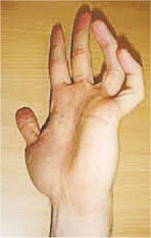 「爪狀手」（claw hand，圖）（作者提供）