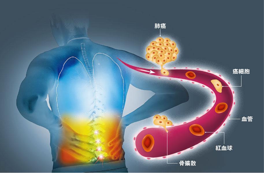骨擴散——晚期肺癌、乳癌、前列腺癌，轉移至骨頭的機率較高；轉移部位多發生於脊椎、肋骨、盆骨、大腿骨和上臂骨。（Sinenkiy、ttsz@iStockphoto/明報製圖）