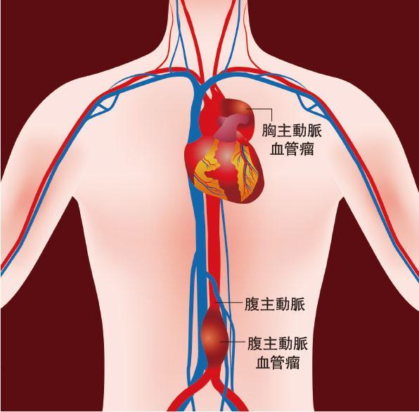 主動脈血管瘤——主動脈是人體最大的血管，負責從心臟運送血液到身體各主要器官。主動脈血管瘤可出現在主動脈不同位置，包括胸主動脈、腹主動脈等，其中以腹主動脈血管瘤最為普遍。（chombosan@iStockphoto/明報製圖）