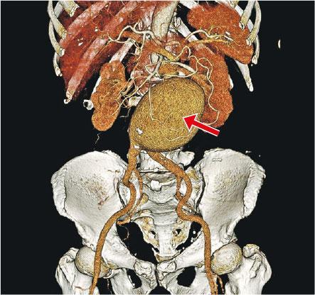 病人接受電腦掃描（CT Scan）時，偶然發現腹部有一個大的主動脈血管瘤（紅箭嘴示）。（港大醫學院提供）