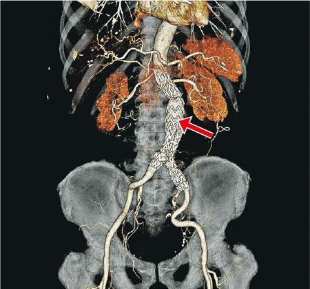 病人接受腹主動脈血管瘤微創手術，手術後的電腦掃描顯示，覆膜支架成功植入主動脈（紅箭嘴示）。（港大醫學院提供）