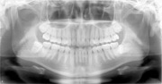 口齒生香：牙科照X光 輻射量較自然環境低