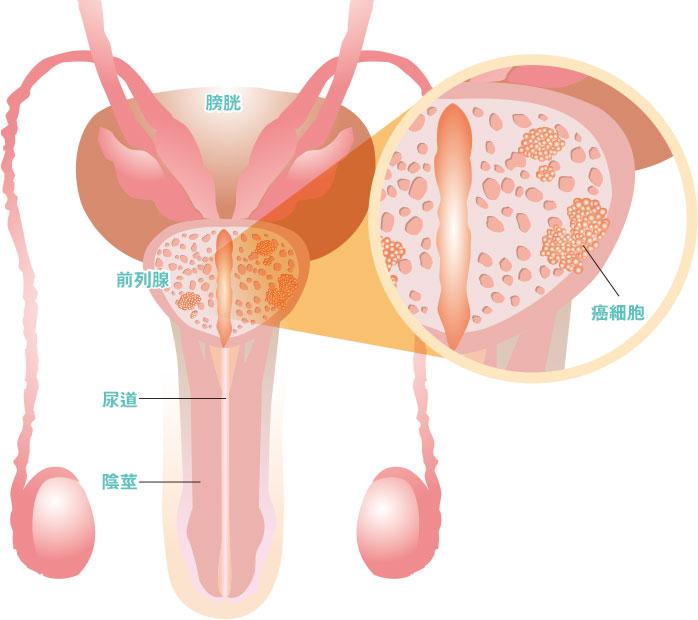 升幅最高——2017年有2240宗前列腺癌發病個案,升幅為眾癌病之冠,屬香港男性常見癌症第3位。(明報製圖)