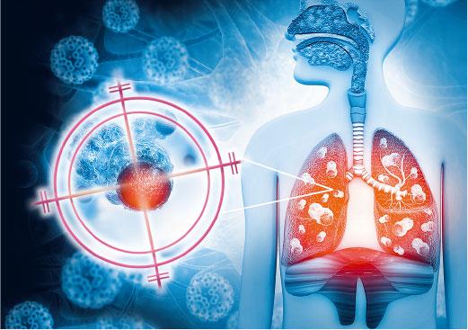 【肺癌】早期無病徵 57%新症屬第四期 「大包圍」檢測基因 精準狙擊晚期肺癌
