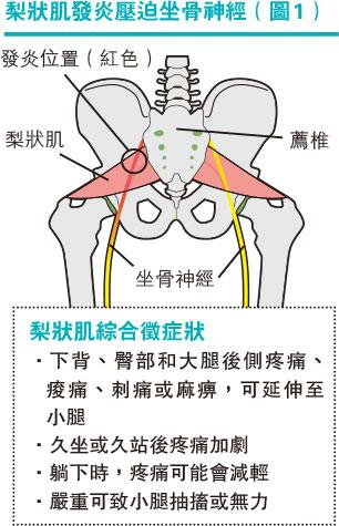 【痛症】跑步後下背、臀、大腿後側痛？測試和了解梨狀肌綜合徵4個症狀