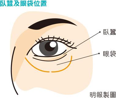 拆解3類黑眼圈成因 未必與熬夜、睡眠有關？中西醫對付眼袋熊貓眼魚尾紋有法