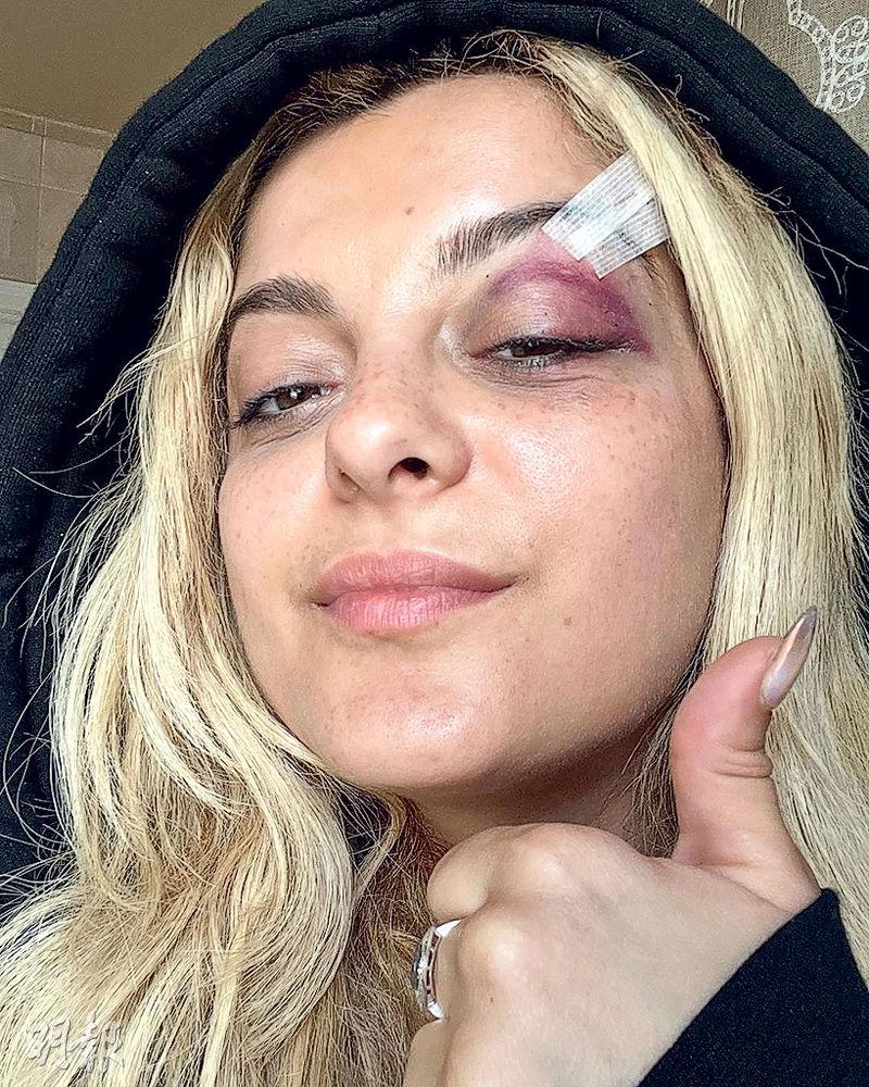 Bebe Rexha上月遭樂迷掟上台的手機所傷，需要縫針，樂迷被捕及落案起訴。