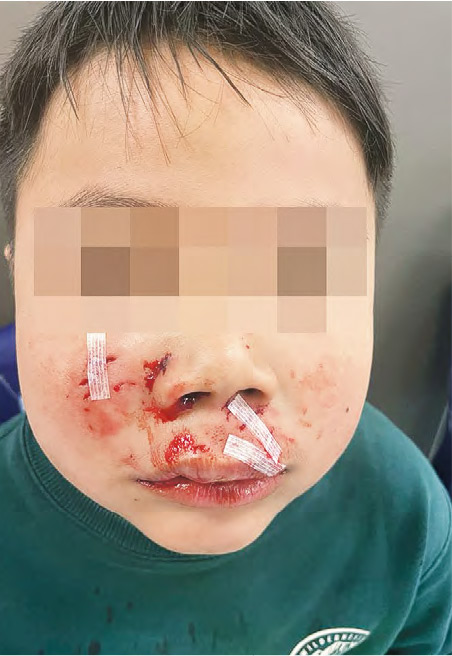 7歲男童上周六遭狗咬傷面部（圖），男童母親鄭太表示，兒子傷口需縫針，亦受驚，需要轉介心理醫生治療。（鄭太提供）